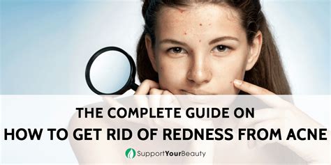 How To Get Rid Of Redness From Acne Updated 2023