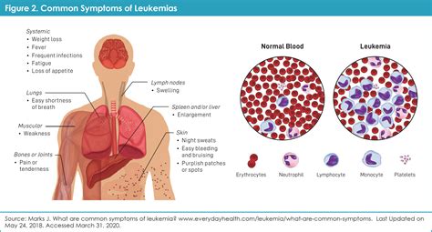 clinical features of the patients with acute myeloid leukemia from hot sex picture