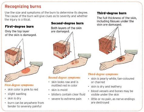Recognizing Burns Use The Size And Symptoms Of The Burn To Determine