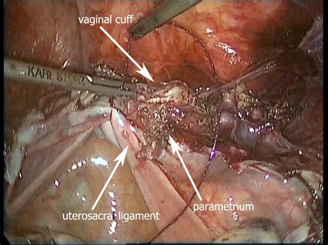 That's another demonstration of anatomy, the pelvic sidewall. Retroperitoneal suture