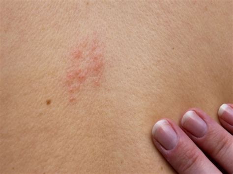 Skin Problems 10 Ways To Treat Dark Skin Patches Dermatologists