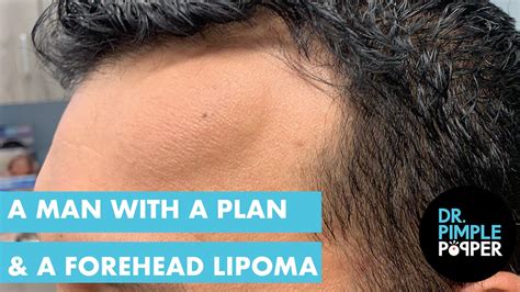 A Man With A Plan And A Forehead Lipoma Lipoma Love Dr Pimple Popper