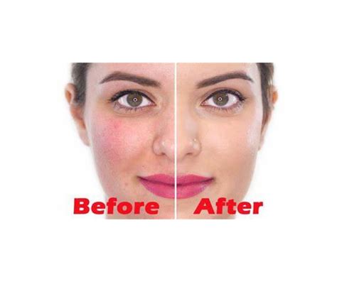 Bontress hair serum is a topical solution used to treat hair loss. NATURAL WAY TO TREAT YOUR SKIN REDNESS