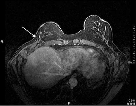 Epidermoid Cyst Of The Breast Mammography Ultrasound Mri Abstract