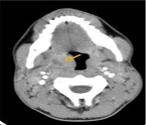 Intratonsillar Abscess Case Series Of A Rare Entity