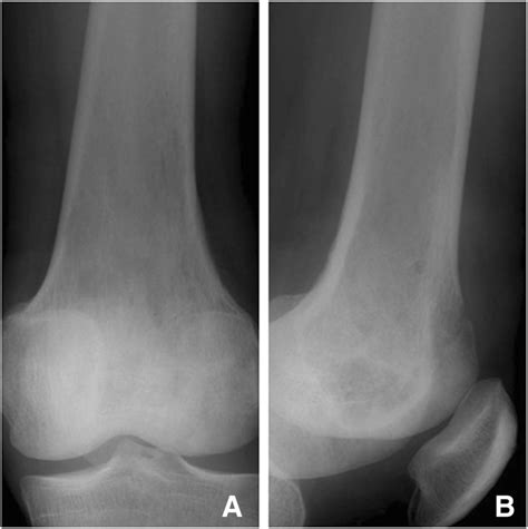 Lgms Of The Left Distal Femur X Ray Revealed Osteolytic Damage And