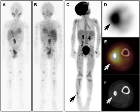Roles Of Petcomputed Tomography In The Evaluation Of Neuroblastoma