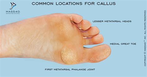 Diagnosis Causes And Treatment Of Callus Mass4d® Insoles And Foot