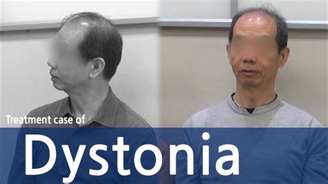 Dystoniacervical Dystoniaspasmodic Torticollis 사경증 치료사례 근긴장이상증