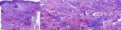 Palisaded Neutrophilic Granulomatous Dermatitis Spectrum Of Histologic