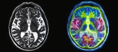 Fmri Vs Spect Scan For The Brain Cognitive Fx
