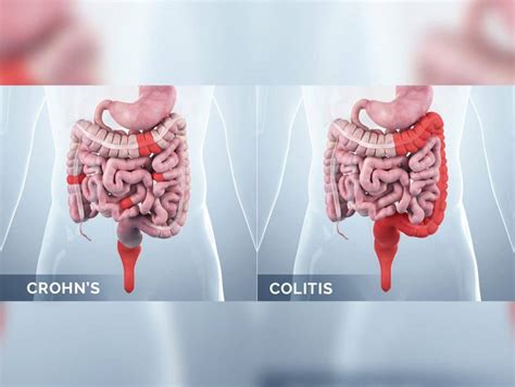 Colite ulcerativa x doença de Crohn qual é a diferença Dor Crônica O Blog