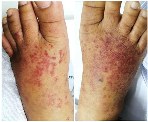 Multiple Non Blanchable Erythematous Macules And Patches On Both Dorsa