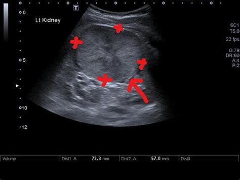 Renal Oncocytoma Ultrasound Wikidoc