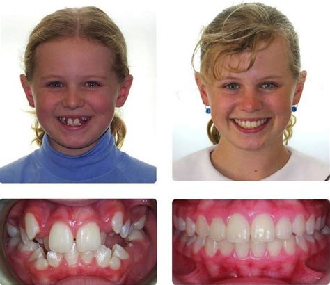 It Is The Best Transformation Of The Teeth Through Braces Before And