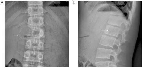 Imaging Features Of Vertebral Aneurysmal Bone Cyst And The Clinical