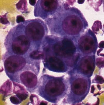 Check spelling or type a new query. Malignant and Borderline Mesothelial Tumors of the Pleura ...