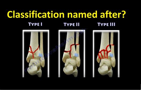 Tibial Pilon Fracture Classification —