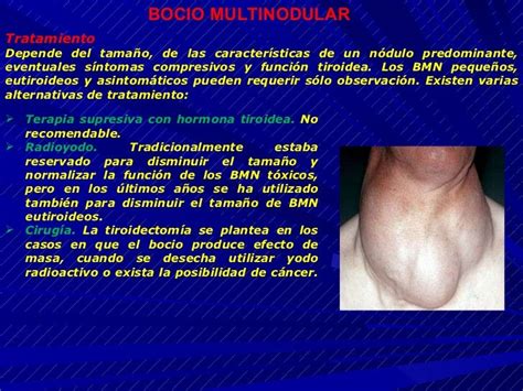 Bocio Multinodular Intratotoracico Caso Clinico