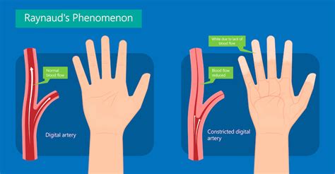 Raynaud Disease The Surgical Clinic