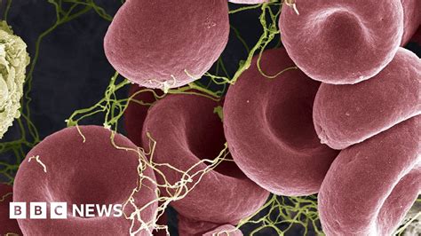 Rare Blood Clots What You Need To Know BBC News