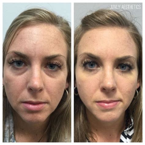 Tear Trough Correction Under Eye Fillers Face Fillers Botox Fillers