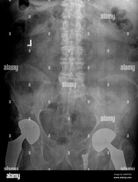 Film Xray Or Radiograph Of A Lumbar Spine Pelvis And Hip Ap Anterior