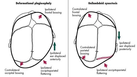 Figure 5 Deformational Plagiocephaly Left Can Be Easily Confused