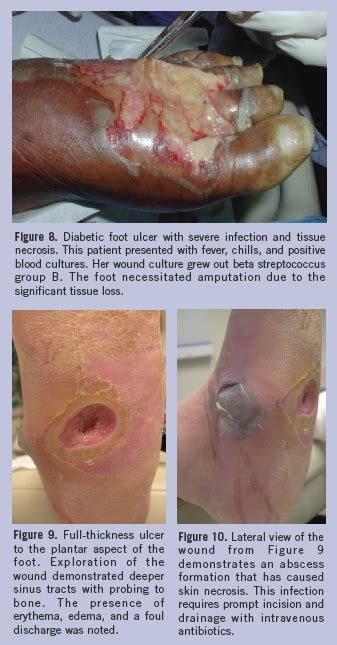 Diabetic Foot Ulcer Stages