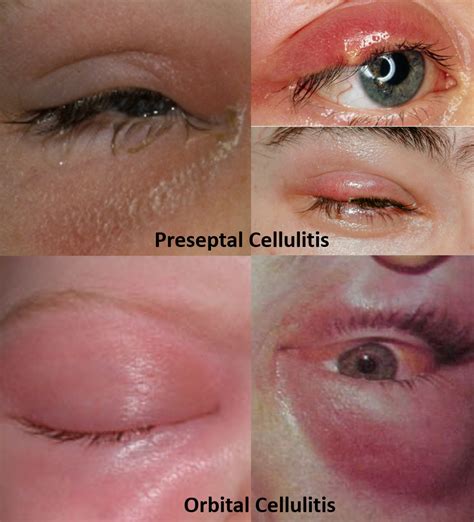Eyelid Swelling Treatment Symptoms Causes Treatment And Prevention Of My Xxx Hot Girl