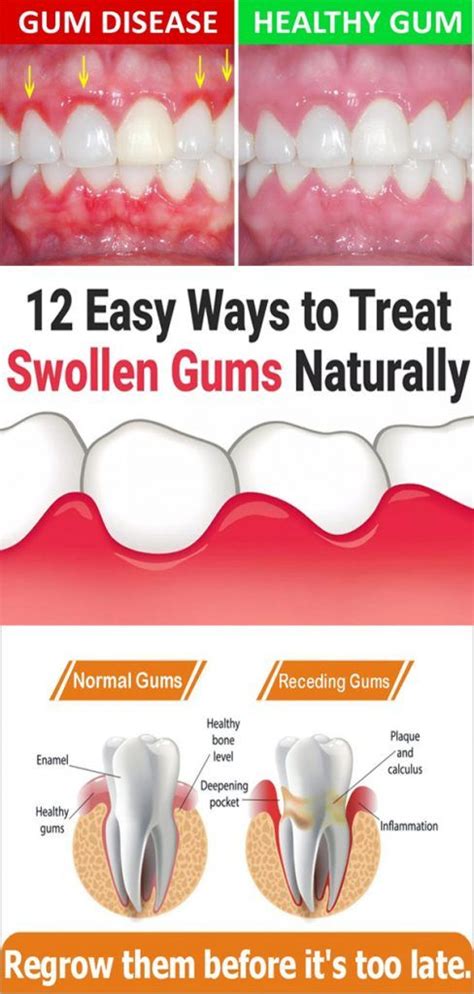 12 Easy Ways To Treat Swollen Gums Naturally Swollen Gum Receding