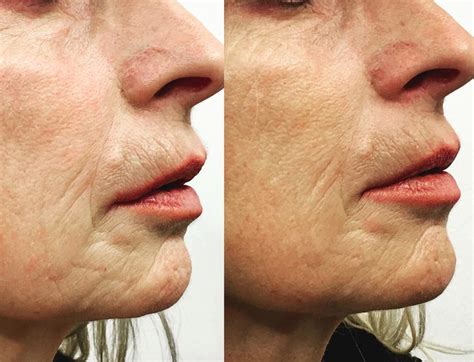 Microneedling is a procedure that uses tiny needles placed in a face roller or automated pen to puncture the very first layer of skin. Micro-needling | SimplySkin Medical Aesthetics