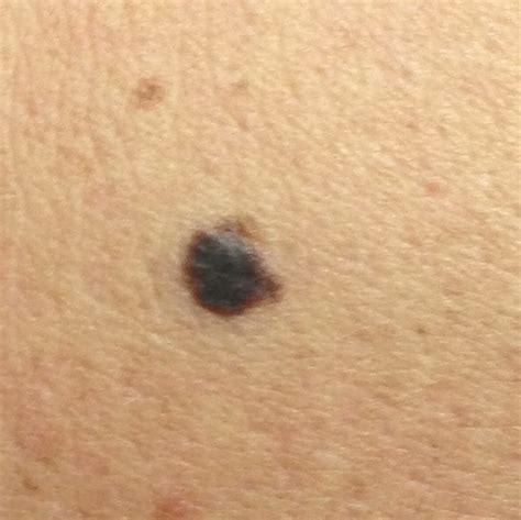 Skin Cancer Lesions On Arms CCF