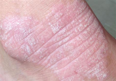 Dermatitis Herpetiformis Causes Treatment Diagnosis Duhring S Disease Evolving World
