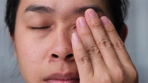 Young woman suffering from eye pain, Allergic to dust, dry eyes, watery