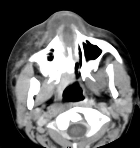 Nasal Septal Abscess Ct Sumers Radiology Blog