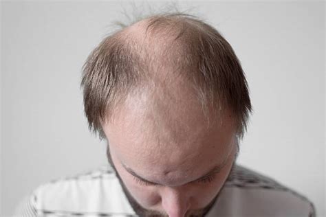 Ugly Bald Men Stock Photos Pictures And Royalty Free Images Istock