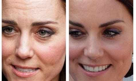 Spa Alega Que Kate Middleton Fez Botox E Palácio Responde Virgula