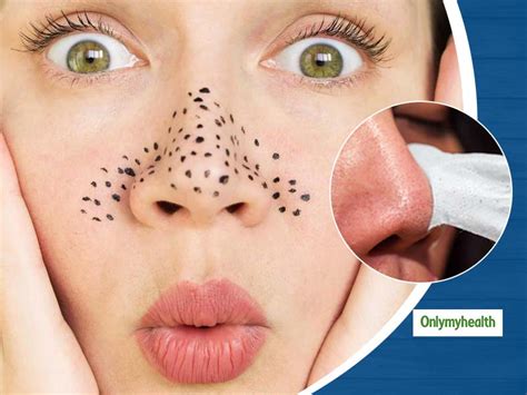 Blackheads On Face Here Are The Causes Symptoms And Treatment