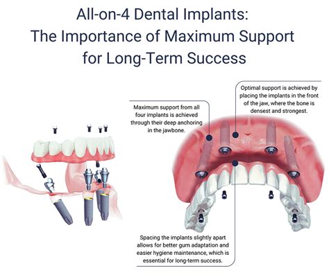 All On 4 Dental Implants Nyc Implant Dentures New York City