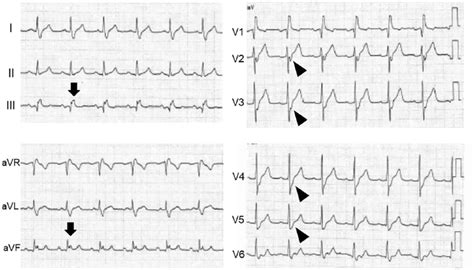 Electrocardiogram Ecg Appears To Show An Elevation Of The St Segments