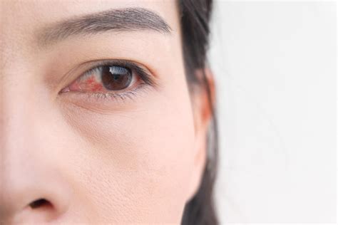 7 Pink Eye Symptoms You Should Know How To Spot