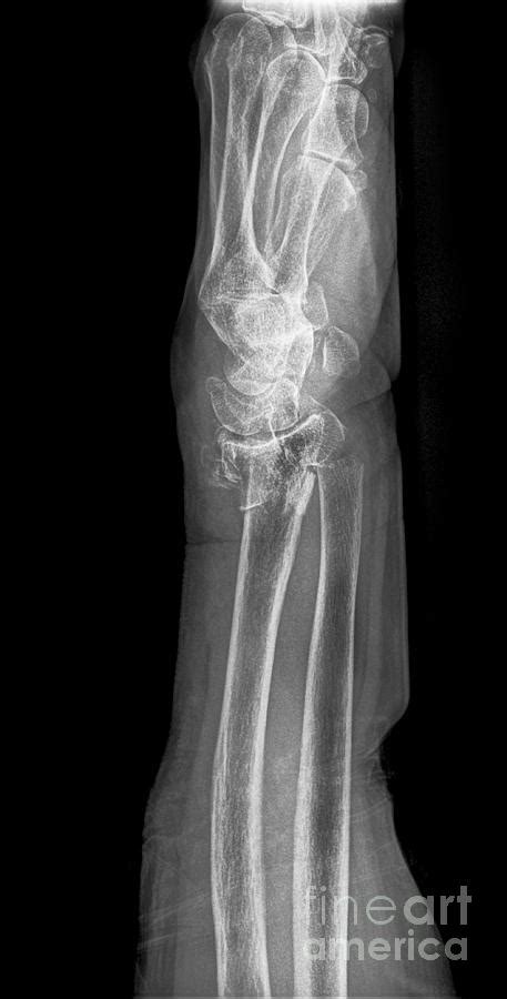 Broken Wrist X Ray Photograph By Science Photo Library