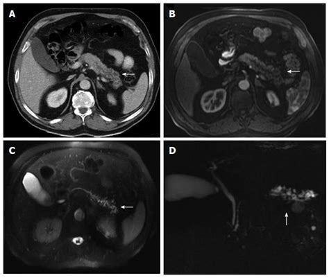 Radiology Of Pancreatic Neoplasms An Update