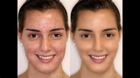 Basic Photoshop Retouching Tutorial Acne And Redness Removal Youtube