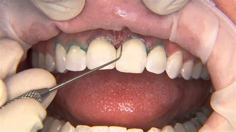 Direct channels allow the customer to buy goods directly from the manufacturer, while an indirect channel moves the product through other distribution channels to get to the consumer. Direct Resin Veneers - A Great Practice Builder! (Item ...