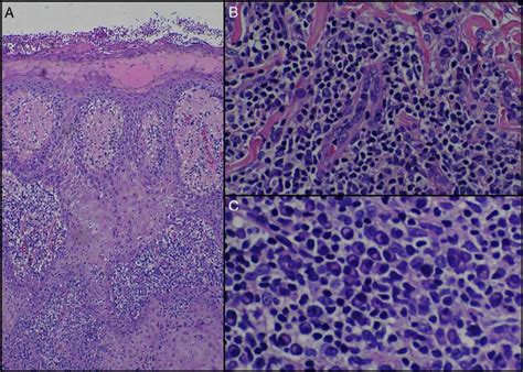 Figure 2 From Malignant Syphilis In An Immunocompetent Patient