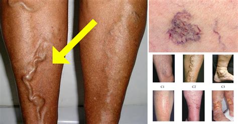 Qual O Sintoma Da Trombose