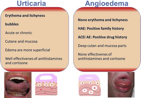 The Angiotensin Converting Enzyme Induced Angioedema Immunology And