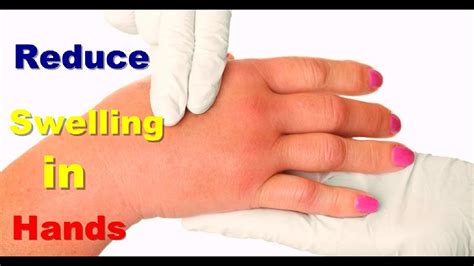 Reduce Swelling In Hands How To Reduce Swelling Naturally How To Treat